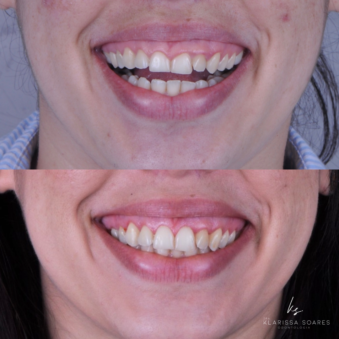 Antes e depois de sorriso